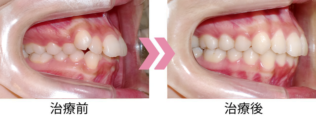 八重歯・叢生の矯正前後の比較写真（側方）