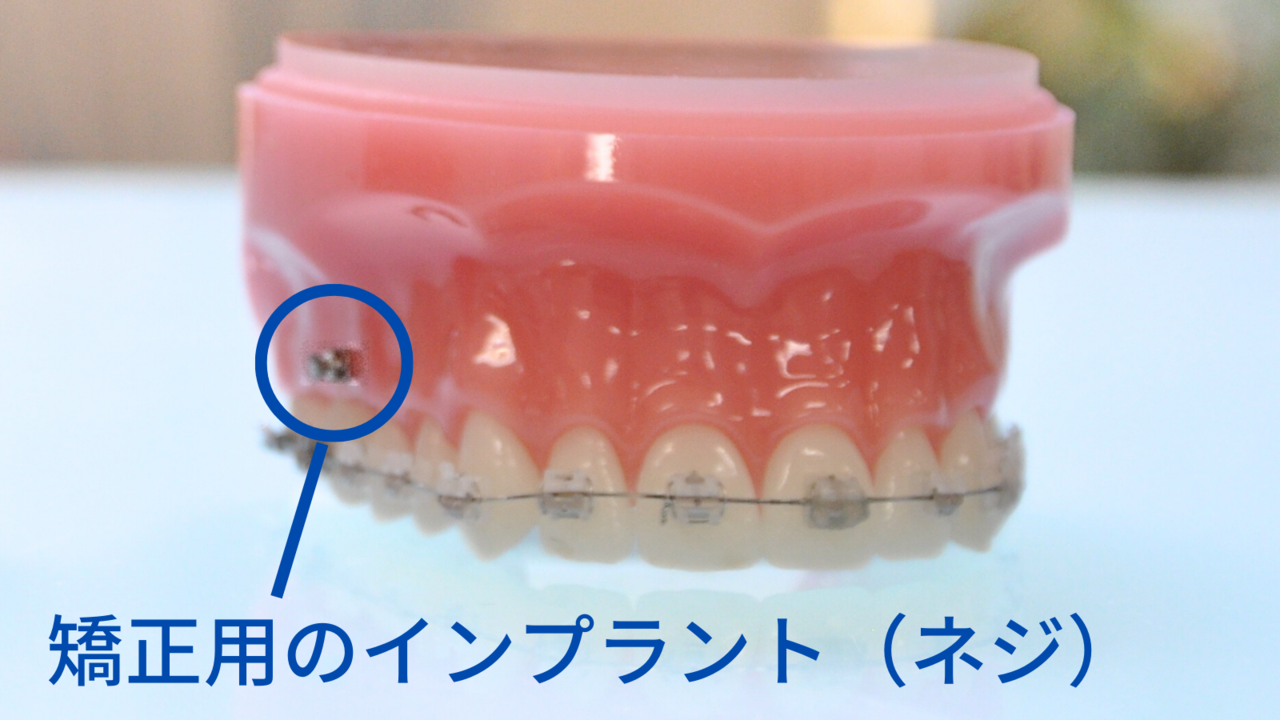インプラント矯正の詳細ページへのリンク